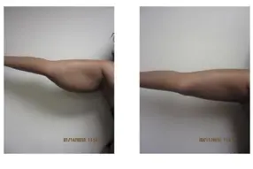 Before and after arm liposuction by Dr. Drew Varano in Washington DC